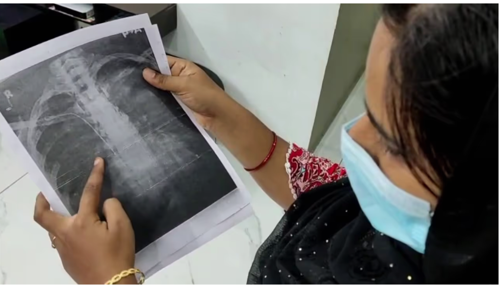  നെഞ്ചില്‍ ട്യൂബ് കുടുങ്ങിയ സംഭവം; ട്യൂബ് തിരിച്ചെടുക്കും, സാധിച്ചില്ലെങ്കില്‍ നഷ്ടപരിഹാരം; ഡോക്ടര്‍ക്ക് പിഴവുണ്ടെങ്കില്‍ നടപടിയുണ്ടാകും