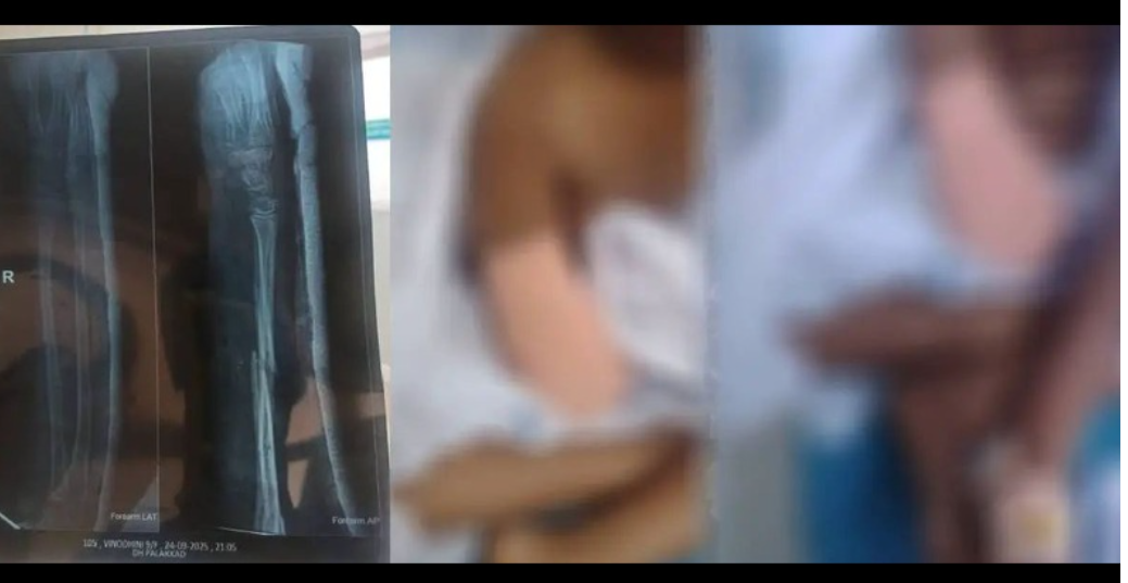 ഒമ്പത് വയസ്സുകാരിയുടെ കൈ മുറിച്ചുമാറ്റിയ സംഭവം;ഡോക്ടര്‍മാര്‍ക്കെതിരെ പരാതിയുമായി കുടുംബം; നീതി കിട്ടിയില്ലെന്ന് ആരോപണം