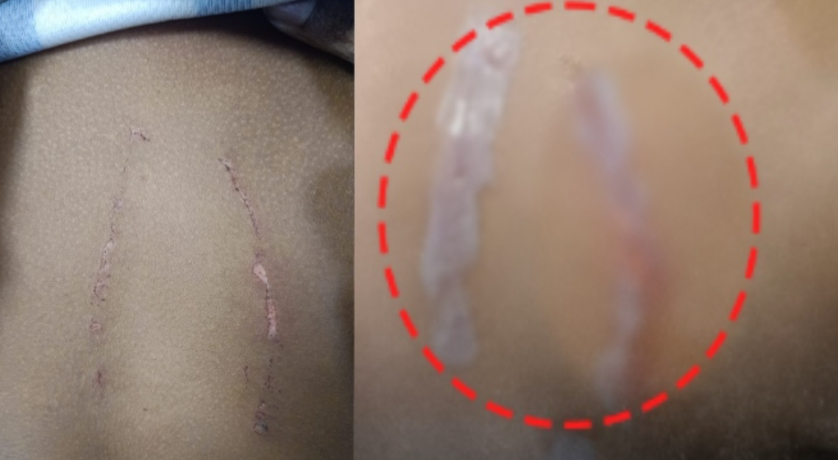 അമ്മയുടെ അടുത്ത് കിടന്നു; 12 വയസ്സുകാരന് അമ്മയുടെ ആൺസുഹൃത്തിന്റെ ക്രൂര മർദനം