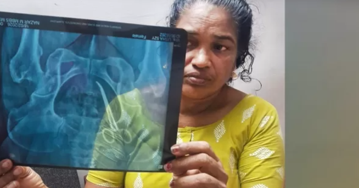 വീട്ടമ്മയുടെ വയറ്റിൽ 5 വർഷമായി കത്രിക: ശസ്ത്രക്രിയക്കിടെ മറന്നുവെച്ചത്; ആലപ്പുഴ മെഡിക്കൽ കോളജിനെതിരെ ഗുരുതര ആരോപണം